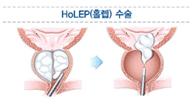 홀렙수술