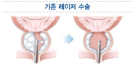 기존 레이저 수술